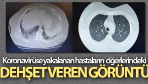 Koronavirüse yakalanan hastaların ciğerlerindeki dehşet veren görüntü